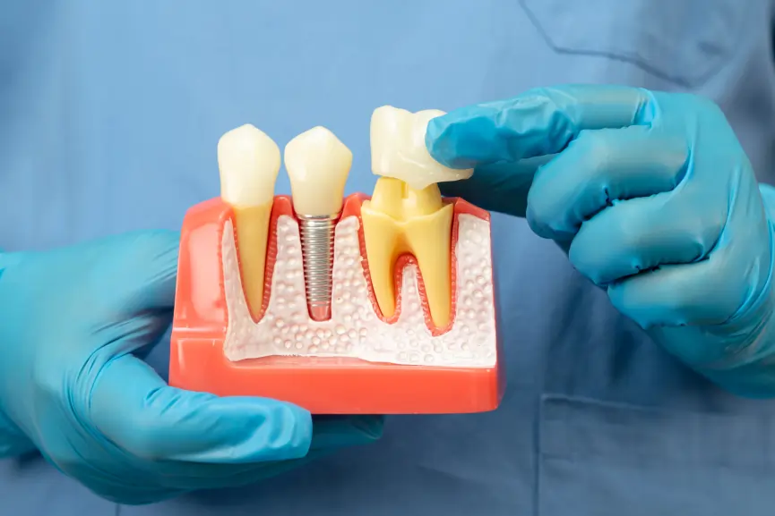 Dental Crowns in Grimsby