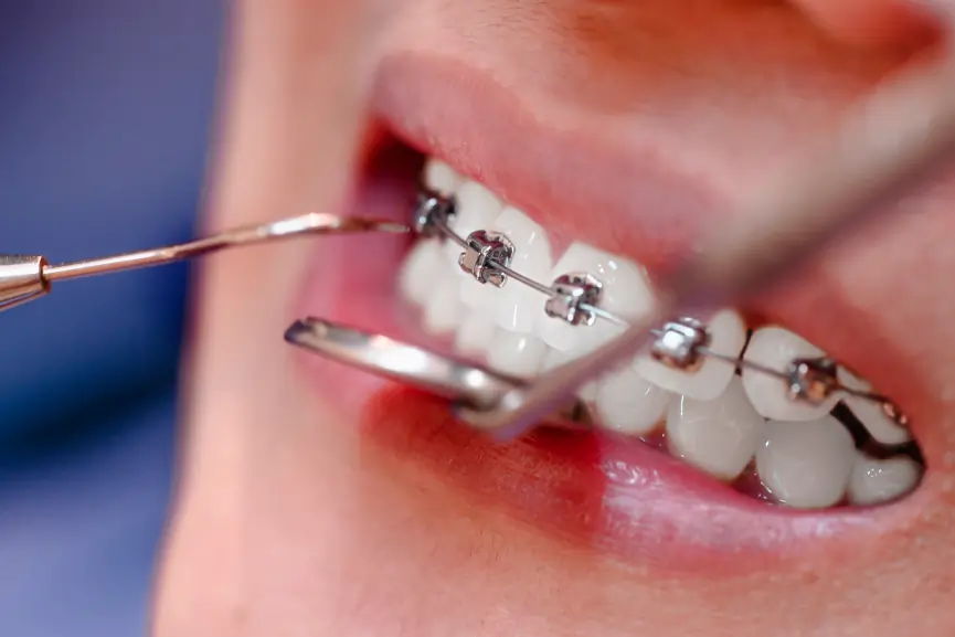 Metal Braces in Grimsby
